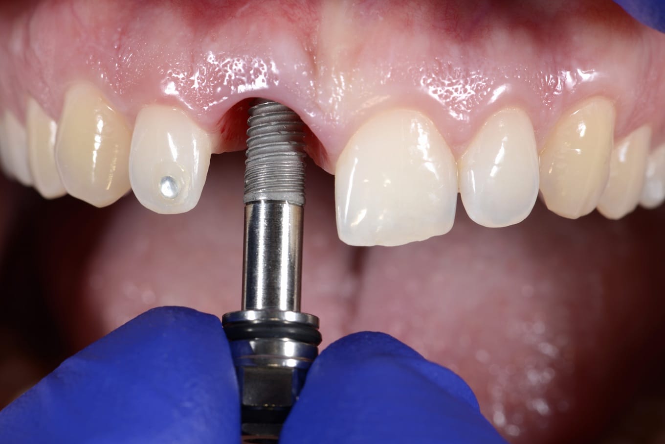 Jak przebiega proces wszczepienia implantu zęba?
